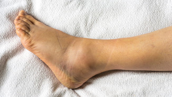How to Best Heal an Ankle Sprain - Ortho Bracing