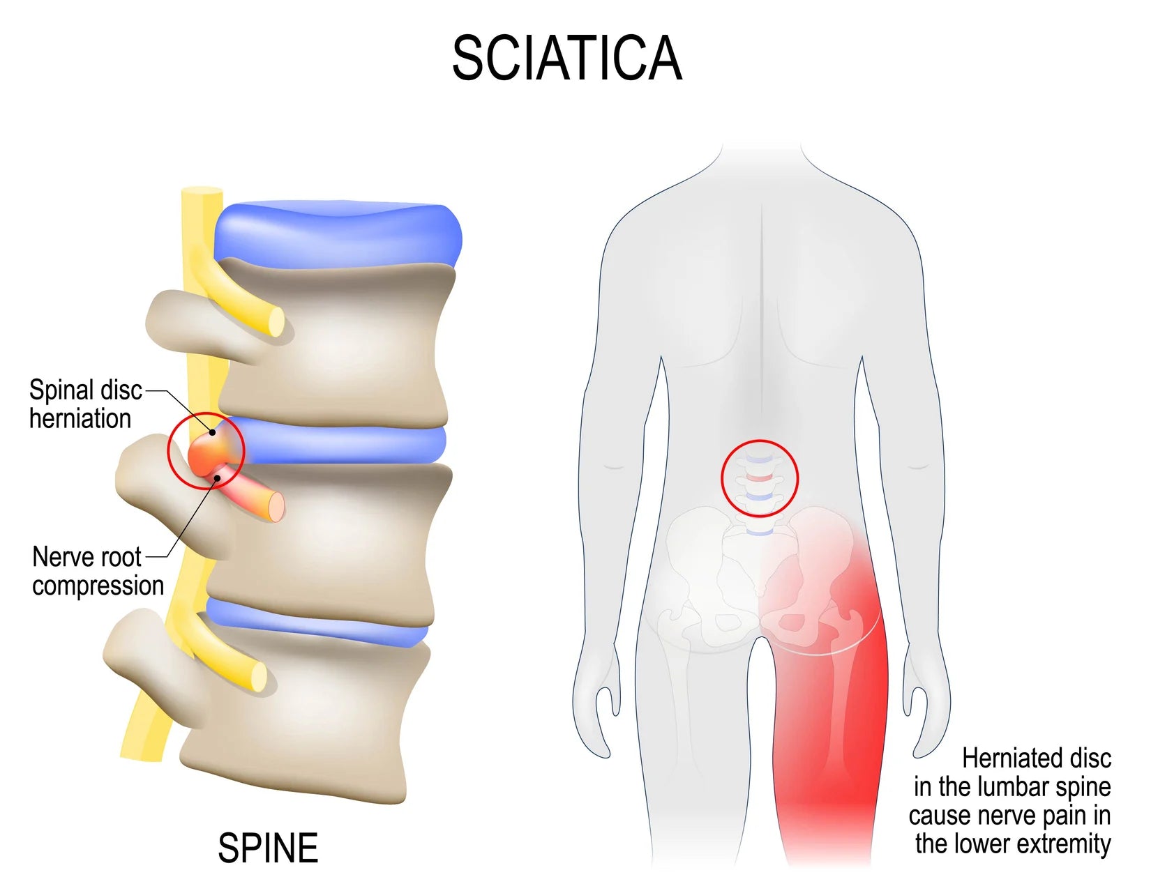 Best brace for sciatica nerve pain