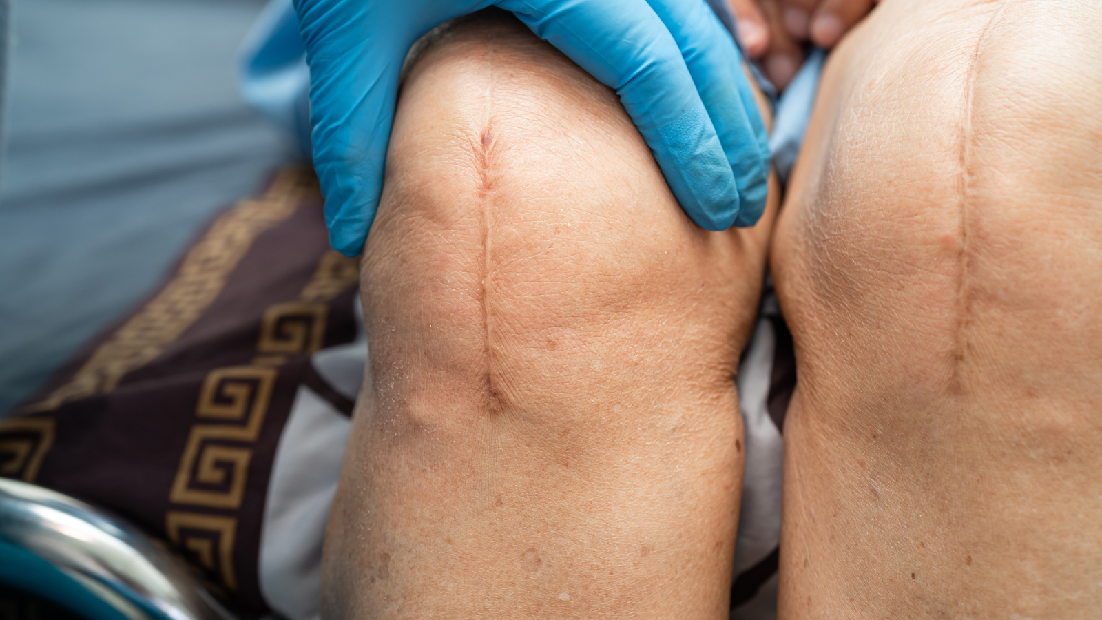 Is Breg Polar Care Safe For Use After A Joint Replacement?